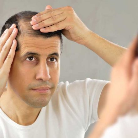 Proređena kosa kod muškaraca-ovo je najbolje rešenje!