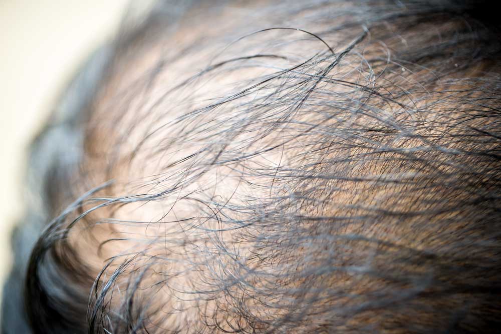 proređena kosa kod muškaraca lečenje