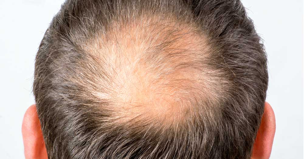 opadanje kose na temenu kod muškaraca