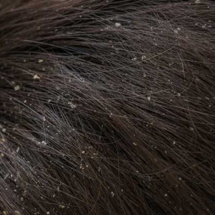 Perut u kosi: kako i zašto nastaje i šta je uklanja