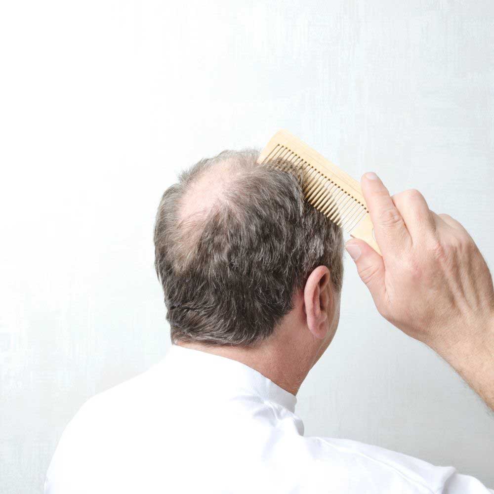 lek protiv opadanja kose kod muškaraca