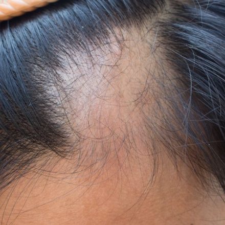 Koliko traje alopecija areata i kako je pobediti?
