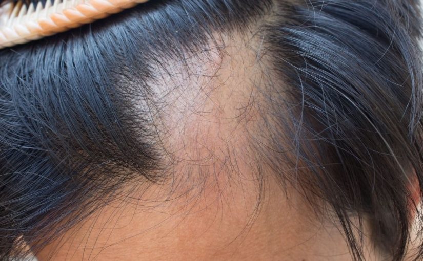 alopecija areata
