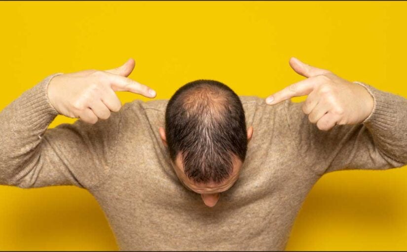 androgena alopecija